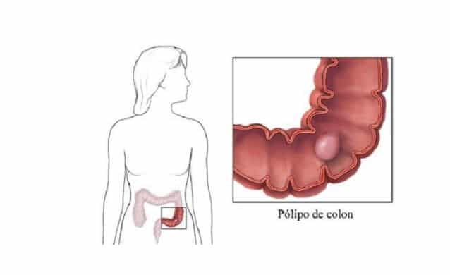 pólipos en el colon